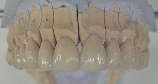 фото верхней челюсти керамики, выполнена симферопольским стоматологом, цены