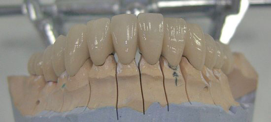 фото нижней челюсти, зубы, керамика, металлокерамика, работа симферопольского стоматолога, Керчь, Крым 